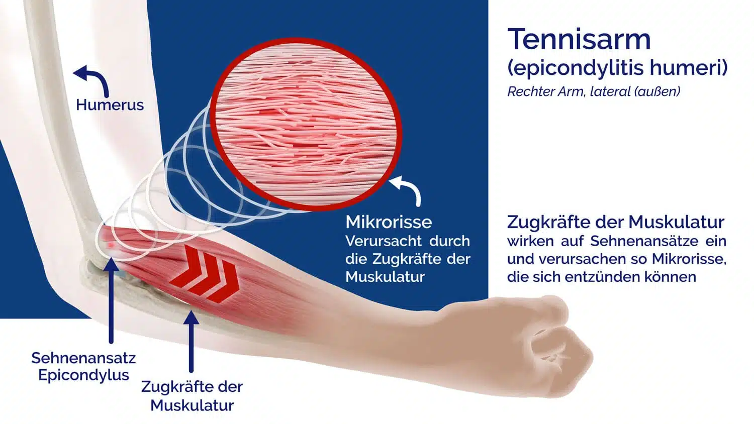 Masalo_Manschette_Ursache_von_Tennisarm_Golferarm_Mausarm_Slider Schaubild Ursache der Epicondylitis, Tennisarm, Golferarm der Masalo KG