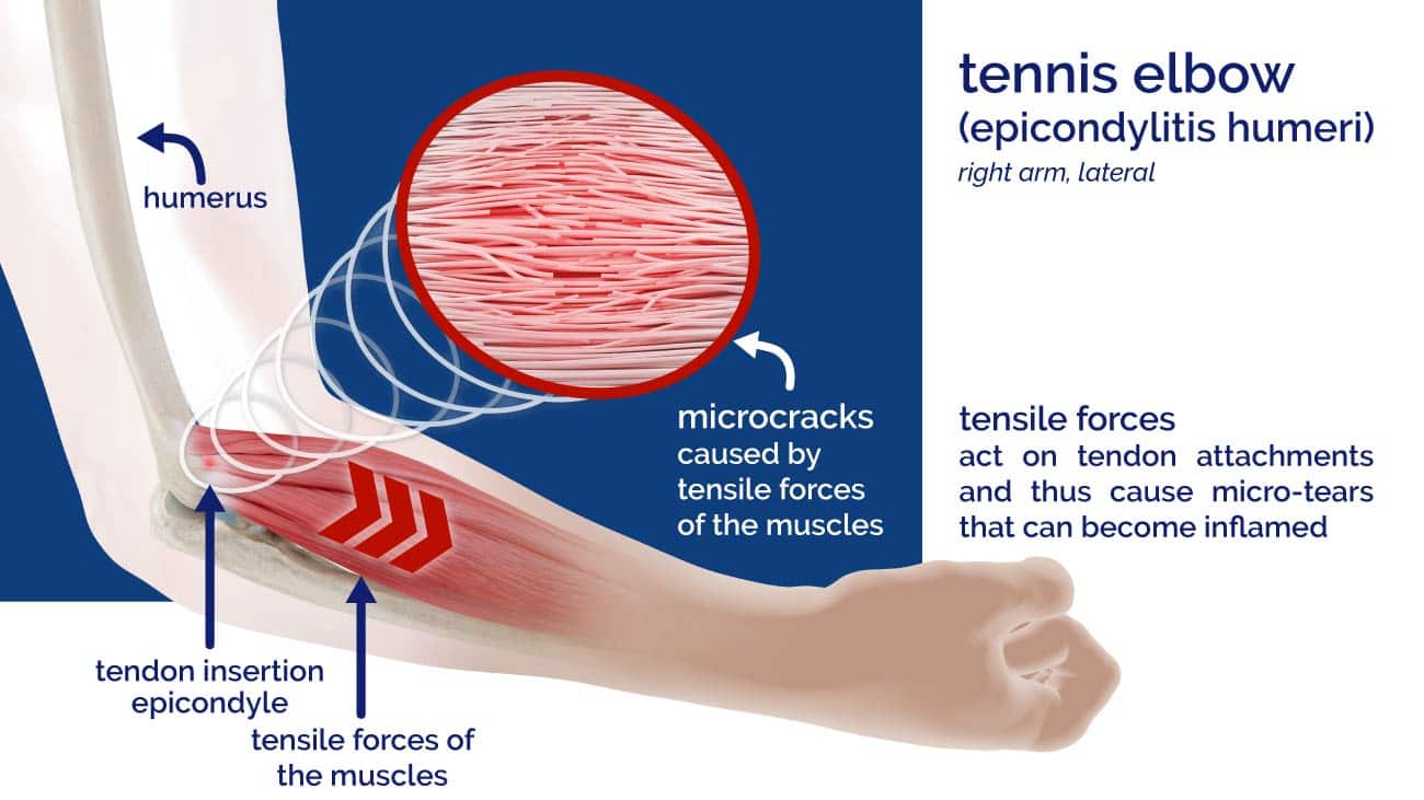 Diagram cause of epicondylitis, tennis elbow, golfer's elbow of Masalo KG.