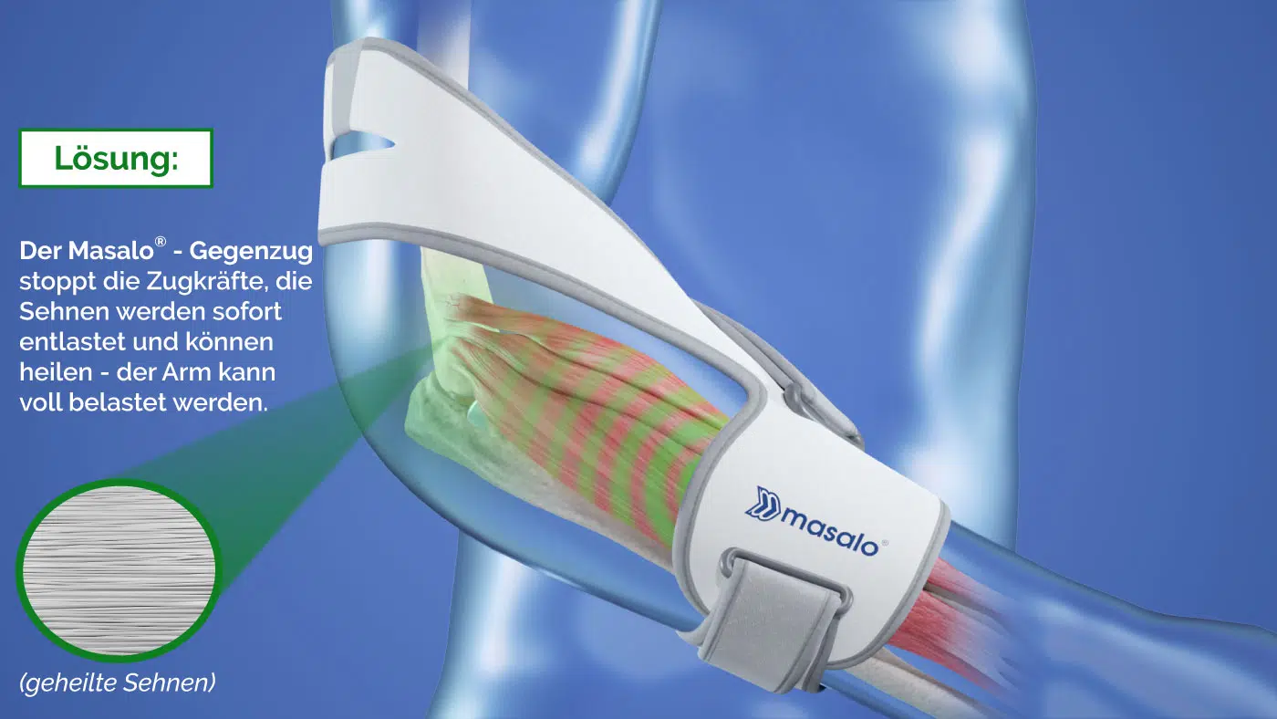 Ursache_Wirkprinzip_Tennisarm_Masalo_Kombi_blauer_Arms Gegenzug Wirkprinzip der Masalo Manschette bei Tennisarm Golferarm Mausarm entlastet sofort